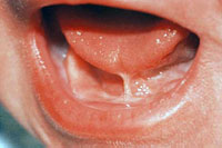 Tongue-tie information and treatment, Portsmouth